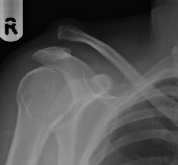 Acromioclavicular (AC) Joint Repair in Bahadurpura, Hyderabad