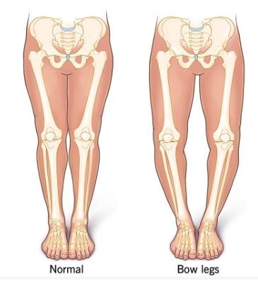 Genu Varum (Bow Legs) Treatment in Bahadurpura, Hyderabad