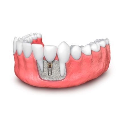 Bone Grafting